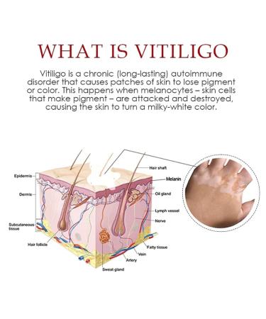 QIMIAN Vitiligo Treatment Spray - Reduces White Spots on Skin - Skin Repair Relief Spray - Pack of 2 - Buy Online on GoSupps.com