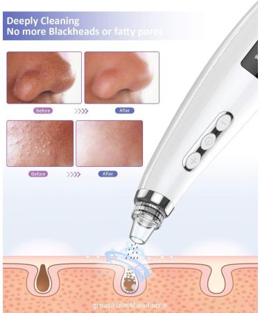2023 Upgraded Blackhead Pore Vacuum Cleaner - Electric USB Rechargeable Acne & Whitehead Extractor with 5 Probes - Blackhead Remover Kit for Women & Men | JHF21 - Buy Online on GoSupps.com