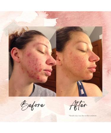 LEROSETT Spot Treatment & Clay Mask - Swedish Clay for Acne Prone Skin - Minimize Pores, Pimples, Blackheads, Detox & Blemishes - All-Natural, Vegan - 3 oz - Buy Online on GoSupps.com