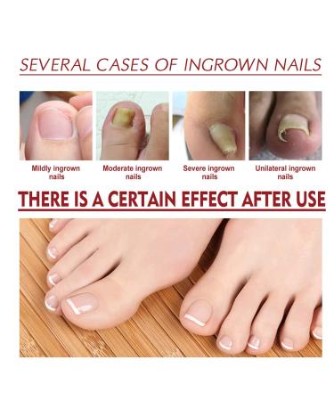 German ToenailPlus Anti Paronychia Relief Oil - Ingrown Toenail Treatment Drops (Pack of 2) - Effective Nail Correction Solution - Buy Online on GoSupps.com