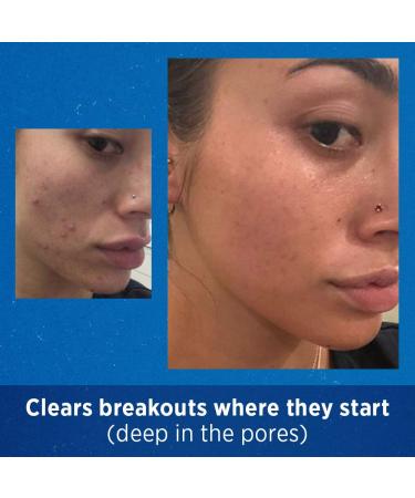 Differin Adapalene Gel 0.1% Acne Treatment | 45g | Prescription Strength Retinoid for Clear Skin - Buy Online on GoSupps.com