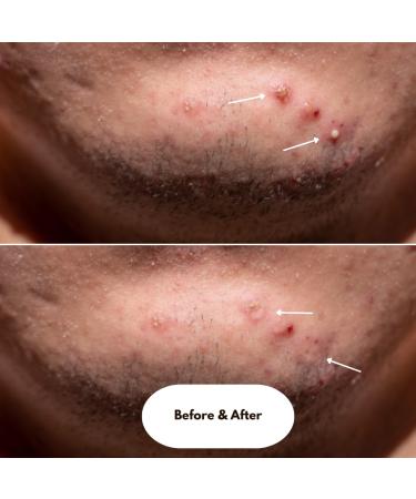 Shuvi Hydrocolloid Acne Blemish Patch - Vegan Cruelty-Free Treatment for Zits & Blemishes | 36 Count - All-Day/All-Night Adhesion - Buy Online on GoSupps.com