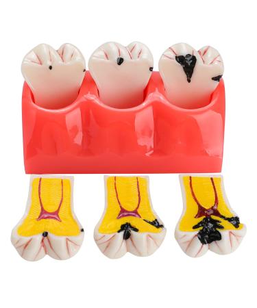 Dental Caries Teeth Model - 4 Times Removable Dental Tooth Decay Model Dental Caries Evolution Model Tooth Pathology Display Model