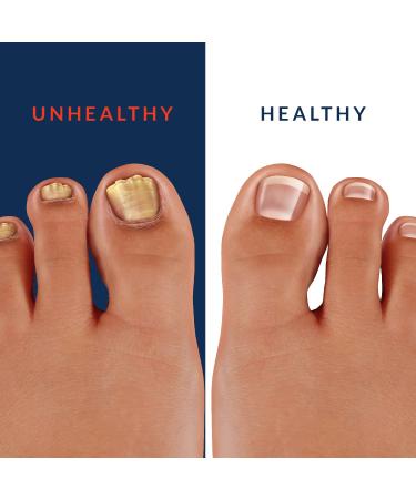 NAIL MAX Anti-Fungal Formula - USA Made Treatment for Finger and Toe Fungus - Maximum Strength Solution for Eliminating Infections - 0.5 fl oz - Buy Online on GoSupps.com