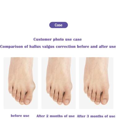 Icehao Toe Valgus Corrector & Bunion Straightener | Joint Pain Relief Aid | 24-Hour Painless Correction | 1 Pair | Complexion - Buy Online on GoSupps.com