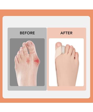 Bunion Corrector Belt - Elastic, Skin-Friendly, Sweat Absorbing, Pain-Relieving - Size Small - Buy Online on GoSupps.com