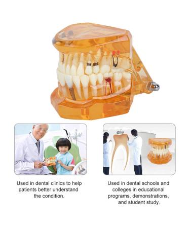 Standard Tooth Model - Removable Dental Teaching Materials for Kids & Adults | Typodont Demonstration Model - Buy Online on GoSupps.com