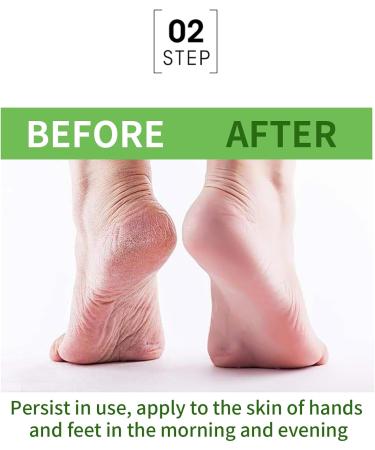 42% Urea Foot Cream - Urea Cream for Feet - Foot Cream for Dry Cracked Heels and Feet - Urea Cream with Salicylic Acid 2% Tea Tree Aloe Vera - Foot Lotion for Deep Moisturize for Thick Rough Skin - Buy Online on GoSupps.com