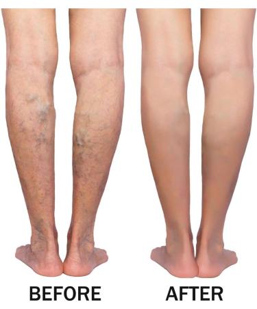 Green Idea Rosskastanien Ointment Gel for Varicose Veins - Leg Cream with Arnica Horse Chestnut & Rutin - 250 ml Pack for Spider Veins & Hemorrhoids - Buy Online on GoSupps.com