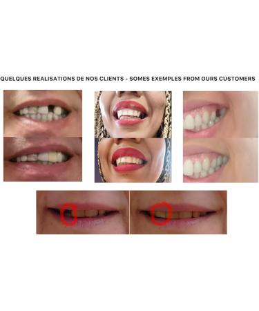 CREADENT Temporary Cosmetic Tooth Replacement Kit - Easy DIY Solution - Buy Online on GoSupps.com