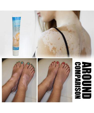 Vitiligo Repair Cream - Herbal Extract Treatment Ointment for Skin Pigmentation 0.7oz - Buy Online on GoSupps.com