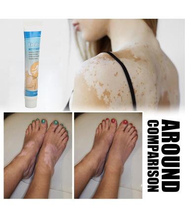 LIULDASHUN Vitiligo Cream - Natural Herbal Extract Treatment Ointment for Skin Pigmentation - 0.7oz - Buy Online on GoSupps.com