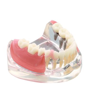 Dental Upper Implantate Model - Upper Overdenture Restoration Model - With superior teeth demo transparent vision soft gum implant nail for education and study model (D)