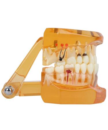 High-Quality Disease Dental Teeth Model - Removable Tooth Implant Demonstration & Teaching Aid in Orange - Buy Online on GoSupps.com