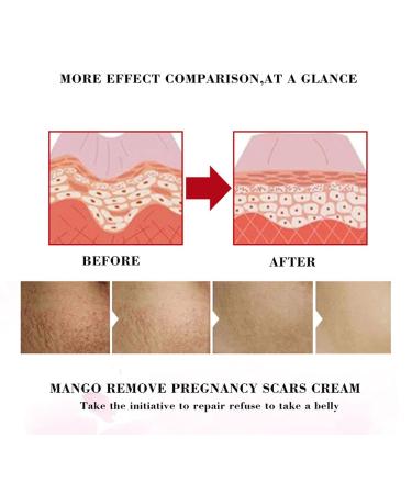 Effective Stretch Marks Removal Cream for Women Targets Pregnancy & Acne Marks Moisturizes & Firms Skin - Buy Online on GoSupps.com