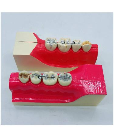 Croix Dentaire Molar Section of the Dents Mod le - Simulation Oral Dents - tude Dents Dentaire Mod le d'Enseignement - Ligne Nerf Dentaire Mod le Inf rieur Dent Tissu D composition