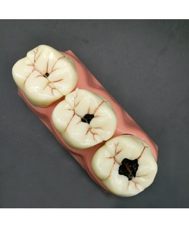 Buy Samnuerly 4-Fold Dental Teeth Caries Model - Removable Tooth Pathology & Evolutionary Display for Dental Training | International Shipping Available - Buy Online on GoSupps.com