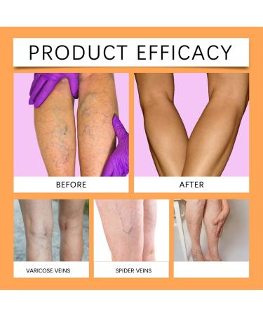 etitek 48 PCS Varicose Veins Treatment for Legs Patch Turmeric Varicose Vein Patch Natural Ingredients Soothing the Legs - Buy Online on GoSupps.com