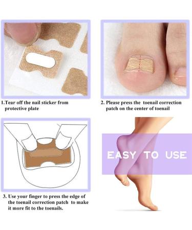 200 Pieces Ingrown Toenails Stickers Toenail Correction Patch Glue-Free Ingrown Curved Toenail Lifter Foot Care Treatment Pedicure Tool (A) - Buy Online on GoSupps.com