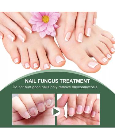 Antifungal Nail Treatment for Damaged Nails - Toe Care Solution for Renewing Discolored Feet - Buy Online on GoSupps.com