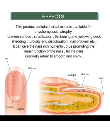 Antifungal Nail Treatment for Damaged Nails - Toe Care Solution for Renewing Discolored Feet - Buy Online on GoSupps.com