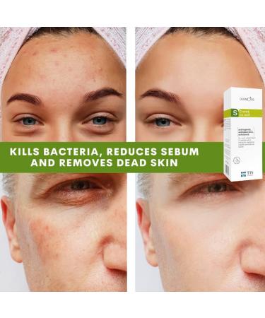 DermoTIS Sulphur 7% Cream for Oily Acne Seborrheic Skin Care Removes Skin Seborrheic Scales Exfoliating Properties Face and Body Unisex - Buy Online on GoSupps.com