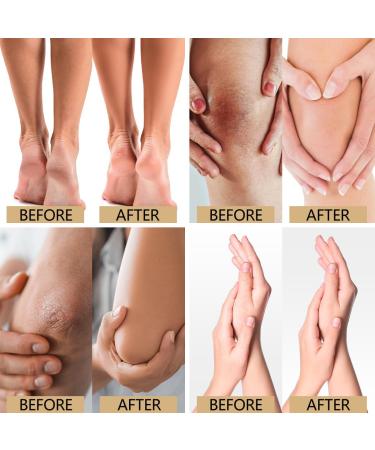 Urea Cream 40% with 2% Salicylic Acid - Ultimate Solution for Rough Dry and Cracked Skin | Moisturize Soften & Smooth for Feet and Body - Buy Online on GoSupps.com