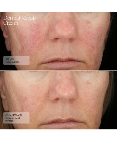 Sent Dermal Repair Facial Cream - Hydrate & Renew Sensitive Rosacea-Prone Skin with HSA Vitamin E & Green Tea - 1.7 Fl Oz - Buy Online on GoSupps.com