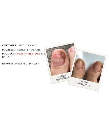Drs. Kline + Green Clear + Restore Nail Treatment 3 Month Supply - 0.90 oz - Buy Online on GoSupps.com