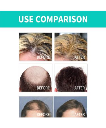 BOKIOESDE Dense Hair Growth Essence Roller Natural Ingredient Regrowth Anti-loss Nourishing Serum Haircare Beauty Supplies - Buy Online on GoSupps.com