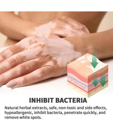Vitiligo Treatment Cream | Natural White Spot Remover | Leukoplakia Relief | 2PCS - Buy Online on GoSupps.com