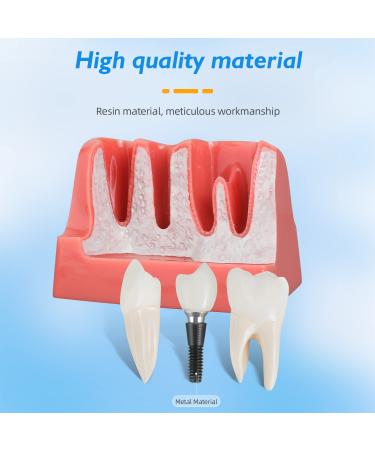 Dental Implant Model - 4 Times Removable Crown Bridge | Educational Teeth Model for Learning & Analysis - Buy Online on GoSupps.com