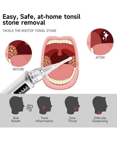 LXIXMQWT Electronic Tonsil Stone Remover with 3 Suction Modes Fresh Breath Clean Oral Care(009) - Buy Online on GoSupps.com