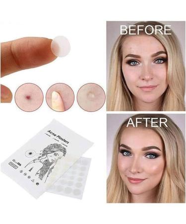 36 Acne Pimple Spot Zit Patches Face Treatment Stickers Pimple Cover Invisible Hydrocolloid Absorbing Cover Up Covering Healing Patch for Concealer Blemish Care + Free Blackhead Zit Remover Tool - Buy Online on GoSupps.com