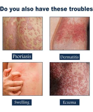Pofeiya Eczema Therapy Spray - Fast Relief from Itching & Dry Skin - All Natural Formula - 3Pcs - Buy Online on GoSupps.com