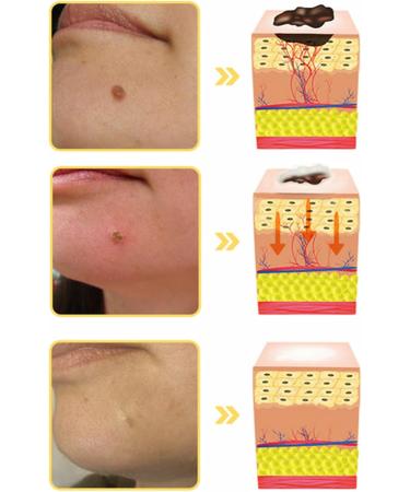 Bee Venom Skin Treatment Cream Skin Removal and Skin Care for Face and Body for All Skin Type Fast and Effective (1Can) - Buy Online on GoSupps.com