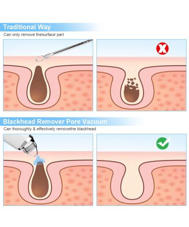 Silkwish Electric Blackhead Remover Pore Vacuum with HD Camera - USB Rechargeable Kit for Women & Men - Buy Online on GoSupps.com