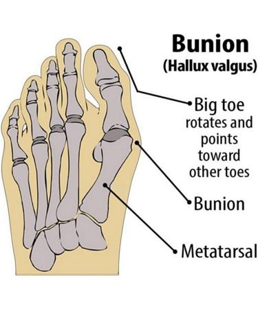 Bunion Corrector Orthopedic Splint for Big Toe Pain Relief 2Pack - Muekday Hallux Valgus Brace for Day/Night Support - Buy Online on GoSupps.com