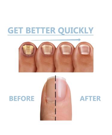 Onyxoguard Nail Growth & Repair Serum | Strengthen Brittle Nails | 5PC Onycholysisheal Conditioner - Buy Online on GoSupps.com