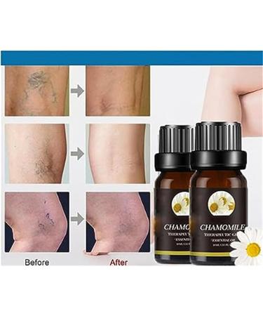 Marrony Oil for Varicose Veins - Essential Marricon-Haramille Treatment for Improved Blood Circulation (5 Pieces) - Buy Online on GoSupps.com