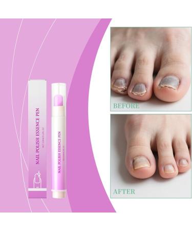 Huile Pour Ongles | 3.5ml Stylo Liquide Nourrissant Fortifiant - Huile De Soin Renfor atrice Pour Cuticules - Pour Femmes Et Hommes Routine Quotidienne Manucure Soin Du Soir Matin Salon Voyage T - Buy Online on GoSupps.com