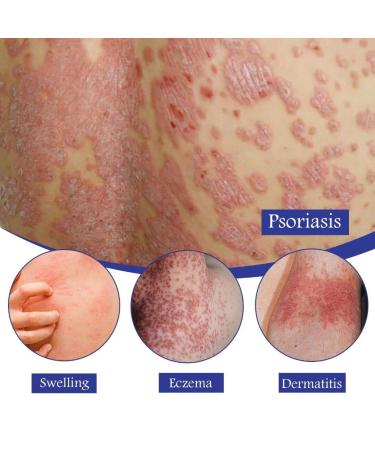 Pruritus Relief: Anti-Itch Treatment Cream Spray 30ML - Buy Online on GoSupps.com