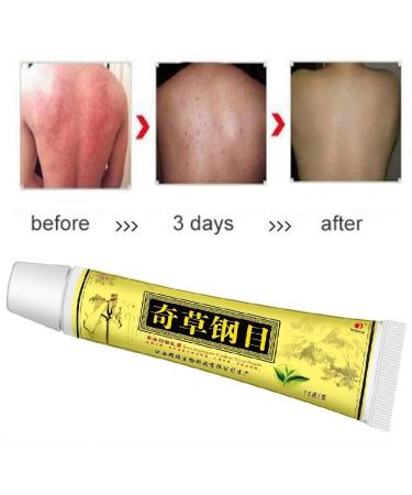 Navyue 5PCS Natural Chinese Herbal Cream for Eczema Psoriasis Dermatitis - Anti-Itch Relief for Inflammation and Rashes - Buy Online on GoSupps.com
