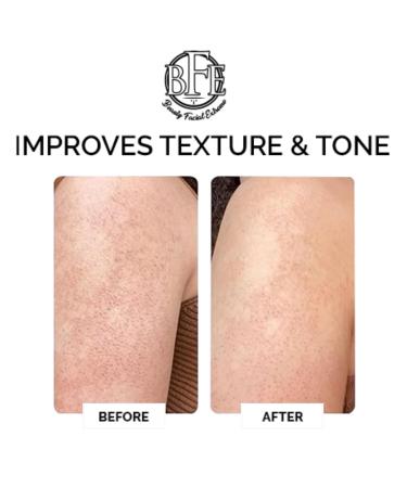 Keratosis Pilaris Exfoliating Body Lotion - 12% Lactic Acid for Smooth Skin | Immediate Moisture & Gentle Exfoliation - Buy Online on GoSupps.com
