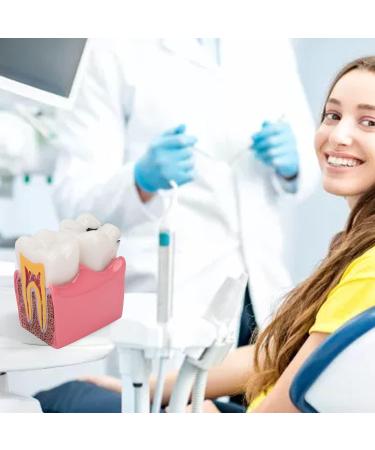 Tooth Caries Model - 6x Enlarged Caries Demonstration for Dental Education | International Shipping - Buy Online on GoSupps.com