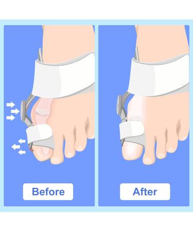 Gushijieju 2 Pack Bunion Corrector for Women Men - Toe Straightener for Bunion Relief - Day Night Support - Buy Online on GoSupps.com