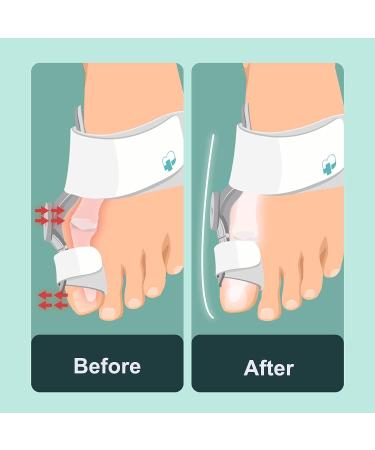 Bunion Corrector Set - Orthopedic Toe Straightener for Men and Women - Adjustable Splint with Toe Separator for Day and Night Relief (2 Pack) - Buy Online on GoSupps.com