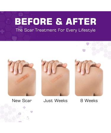Silicone Scar Sheets (1.6 x 120 Roll) - 3M Scar Removal Tape for Softening Acne, C-Section, Keloid Scars - Painless & Reusable - 10-12 Month Supply - Buy Online on GoSupps.com