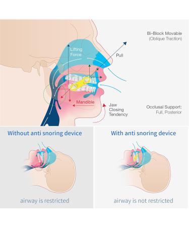 Generic 50PCS Replacement Elastic Straps for Meyson EMA Application (Blue 19mm) 19mm Blue - Buy Online on GoSupps.com
