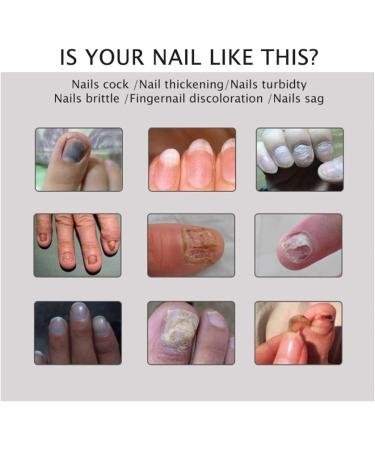  DUBUSH Narc Paronychia Repairing Nail Care Gel restores the appearance of discolored or damaged nails. Instant beauty gel. - Buy Online on GoSupps.com